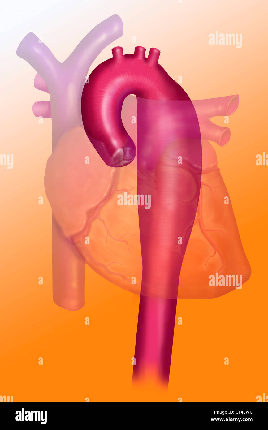 ANEURYSM OF THE THORACIC AORTA Stock Photo