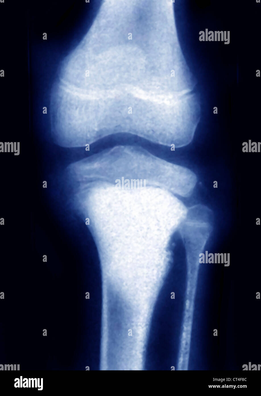 Osteosarcoma knee hi-res stock photography and images - Alamy