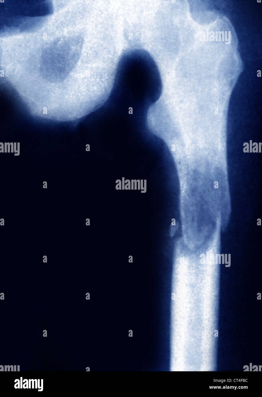 FRACTURED FEMUR, XRAY Stock Photo Alamy