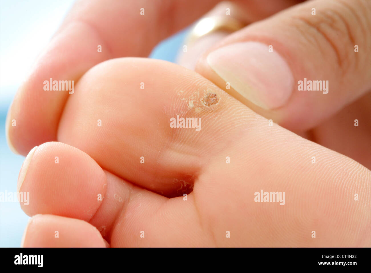 Wart child hires stock photography and images Alamy