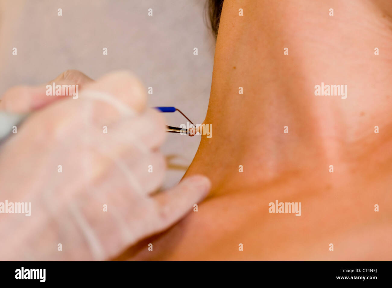 A skin tag or acrochordon on a person's buttocks Stock Photo - Alamy