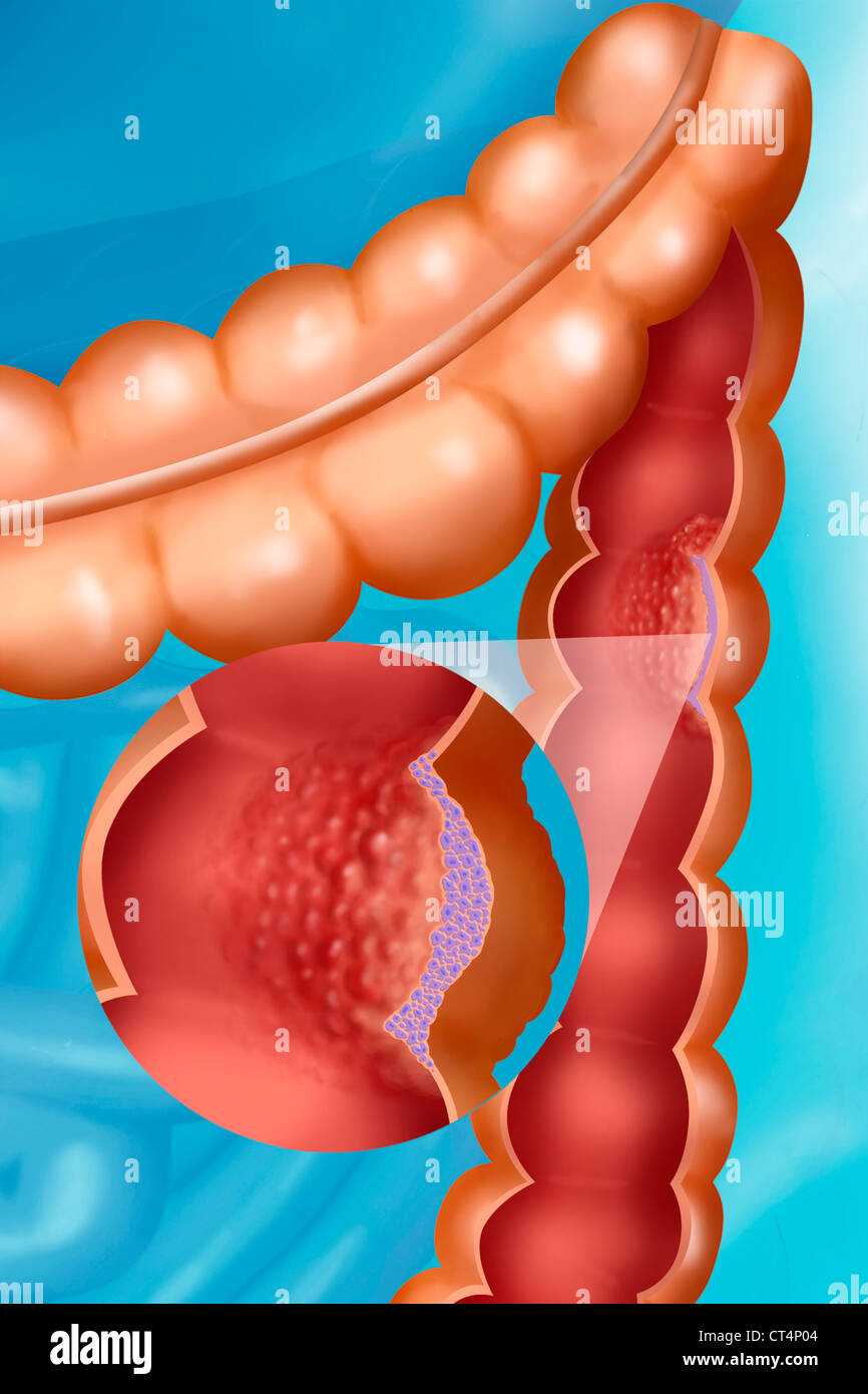 CANCER OF THE COLON, DRAWING Stock Photo
