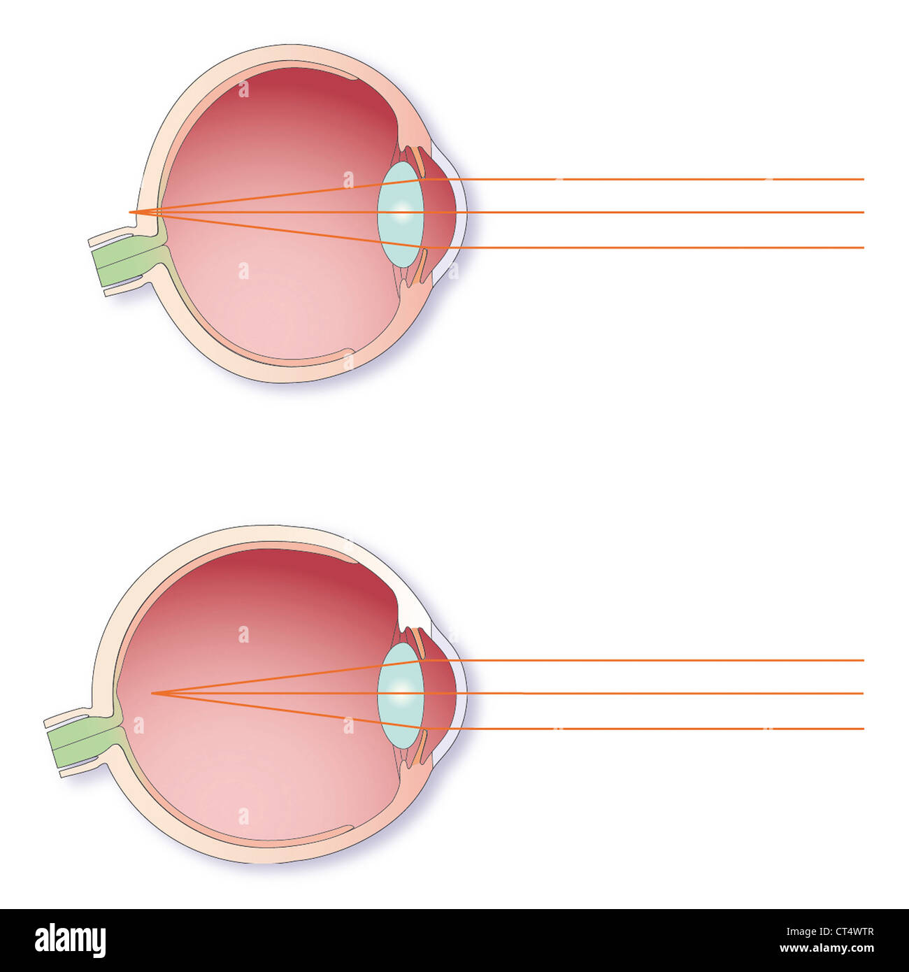 Draw the ray diagram for nearsighted