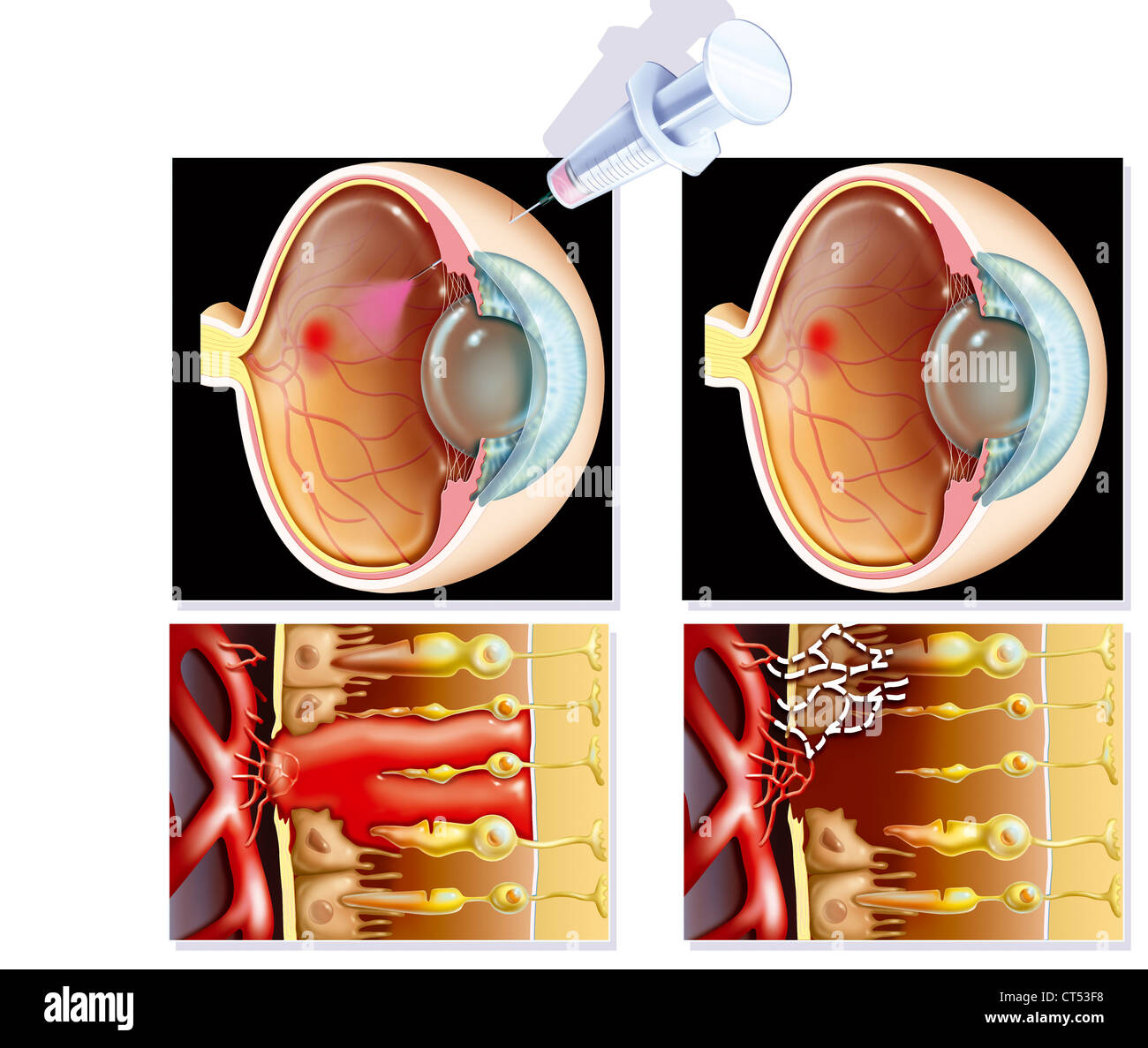 AMD TREATMENT, ILLUSTRATION Stock Photo - Alamy