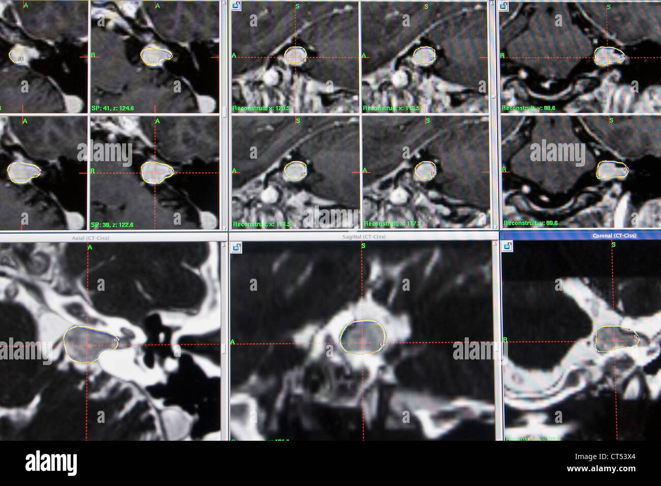 ACOUSTIC NEUROMA, MRI Stock Photo