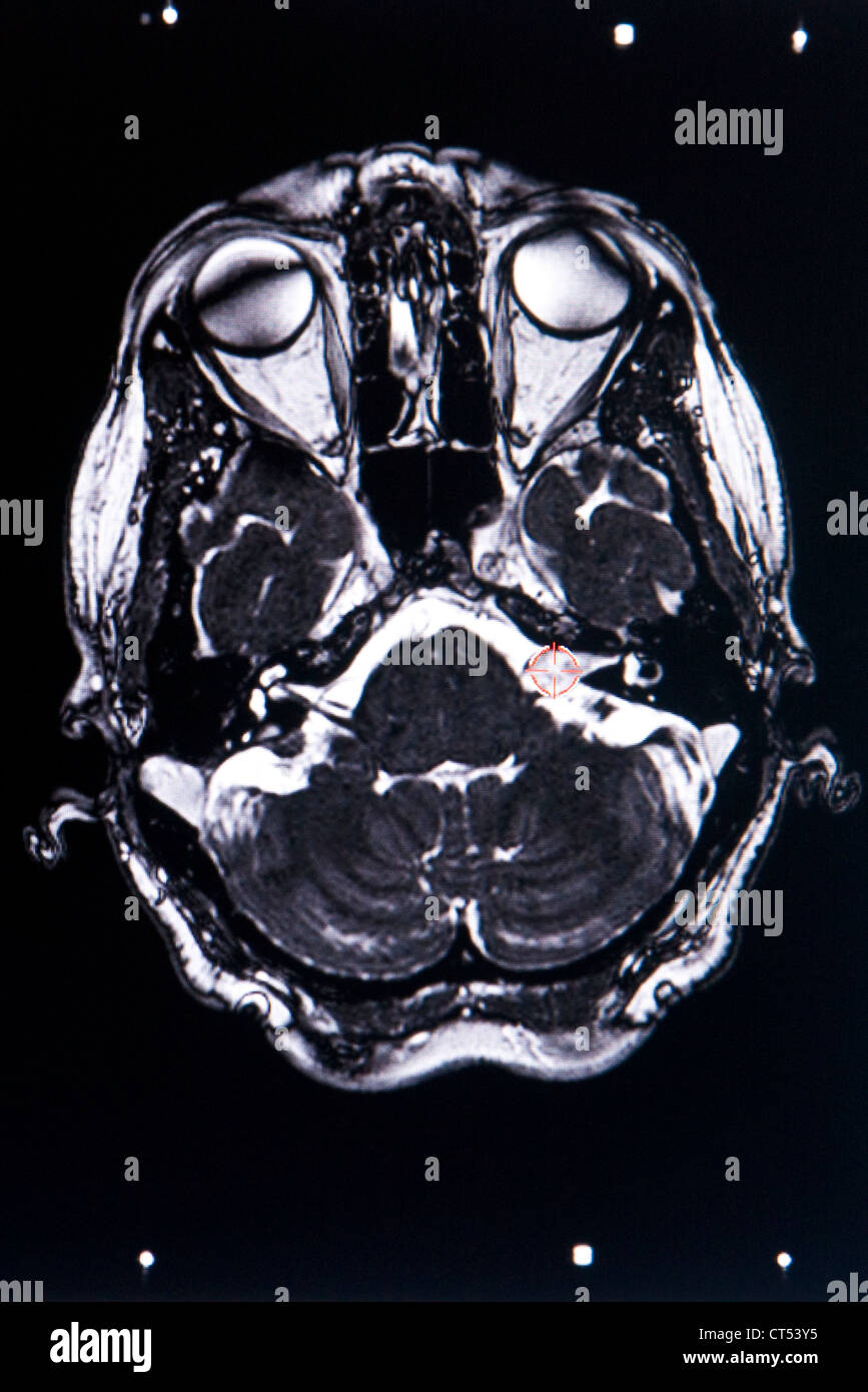 ACOUSTIC NEUROMA, MRI Stock Photo Alamy