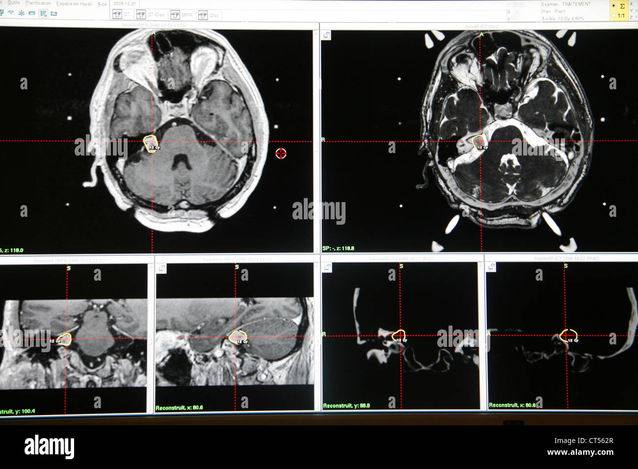 ACOUSTIC NEUROMA, SCAN Stock Photo