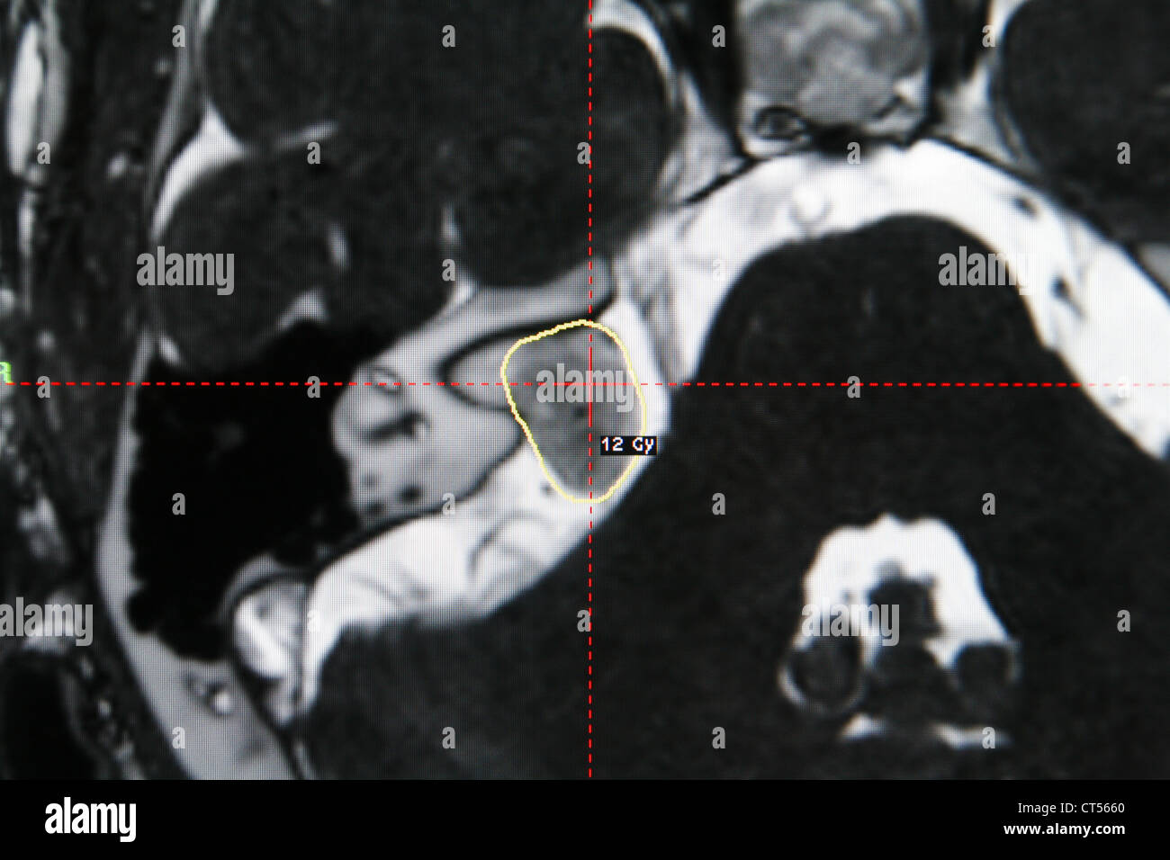 ACOUSTIC NEUROMA, SCAN Stock Photo