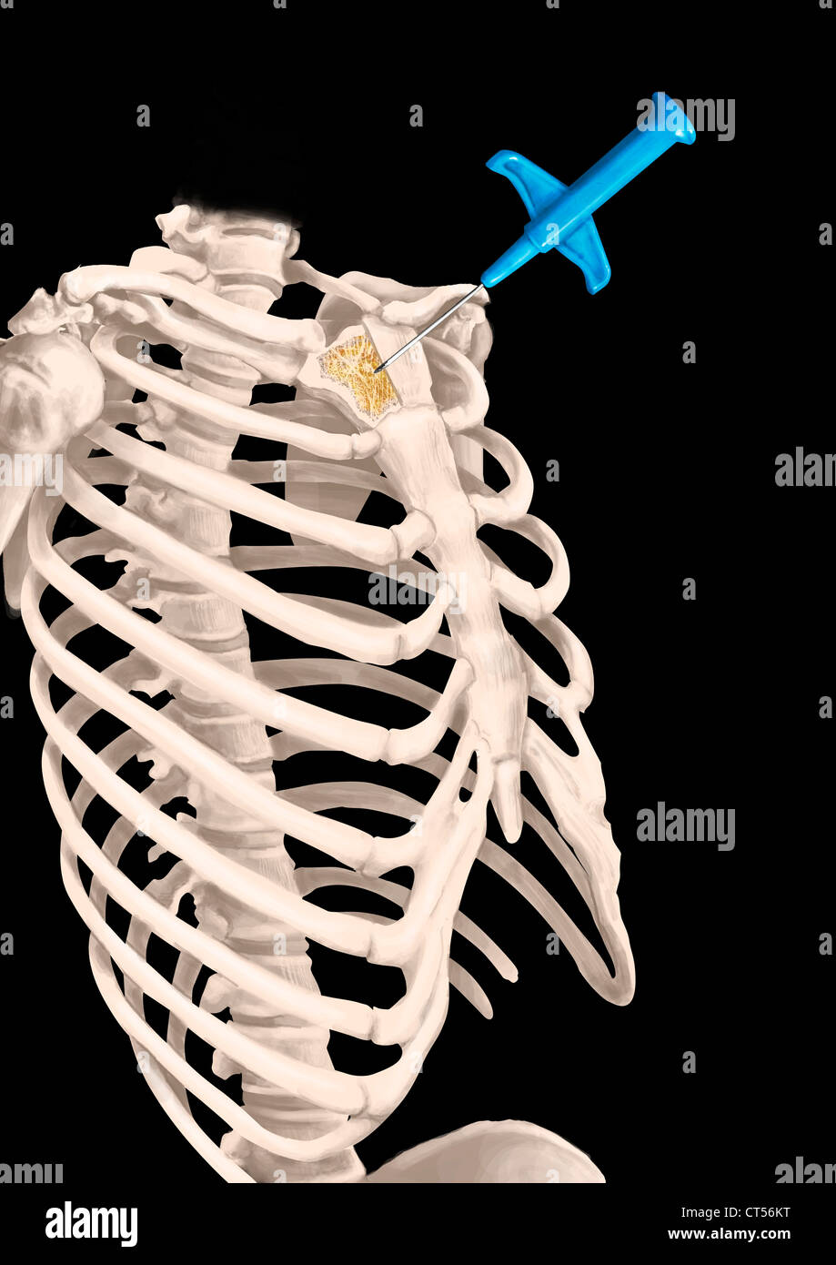 BONE MARROW ASPIRATION Stock Photo Alamy