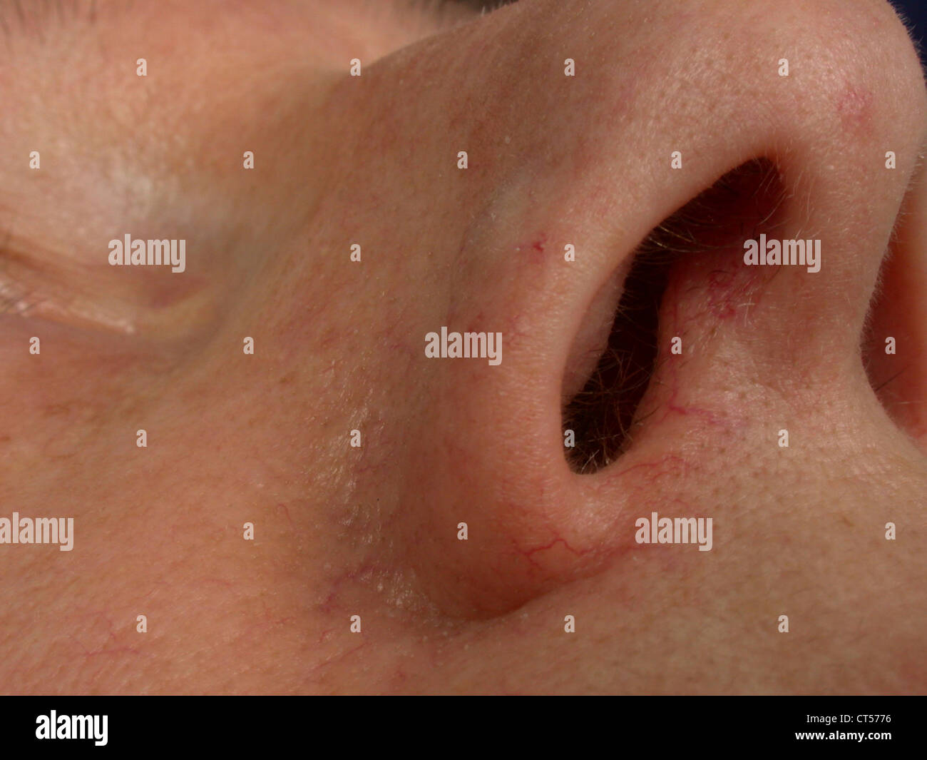 BENIGN SKIN TUMOR Stock Photo