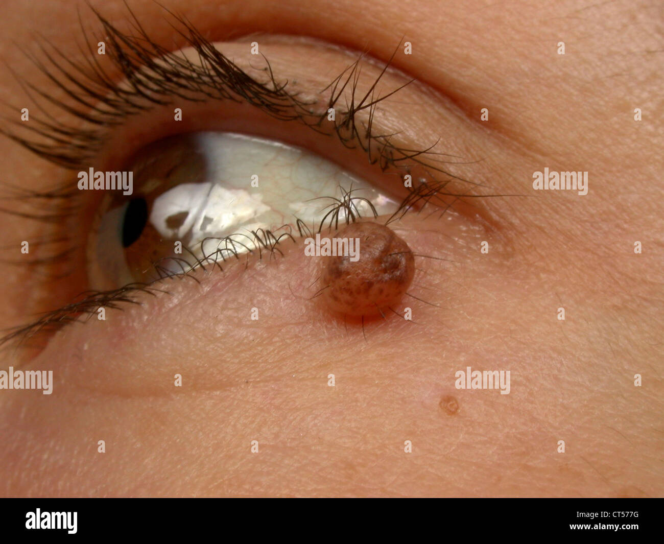 INTRADERMAL NEVUS Stock Photo 49287940 Alamy