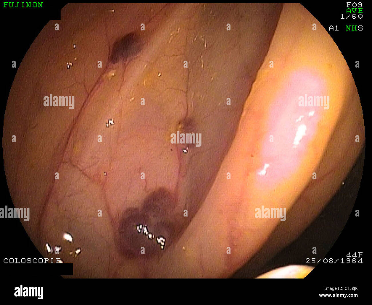 Angioma of the colon hi-res stock photography and images - Alamy
