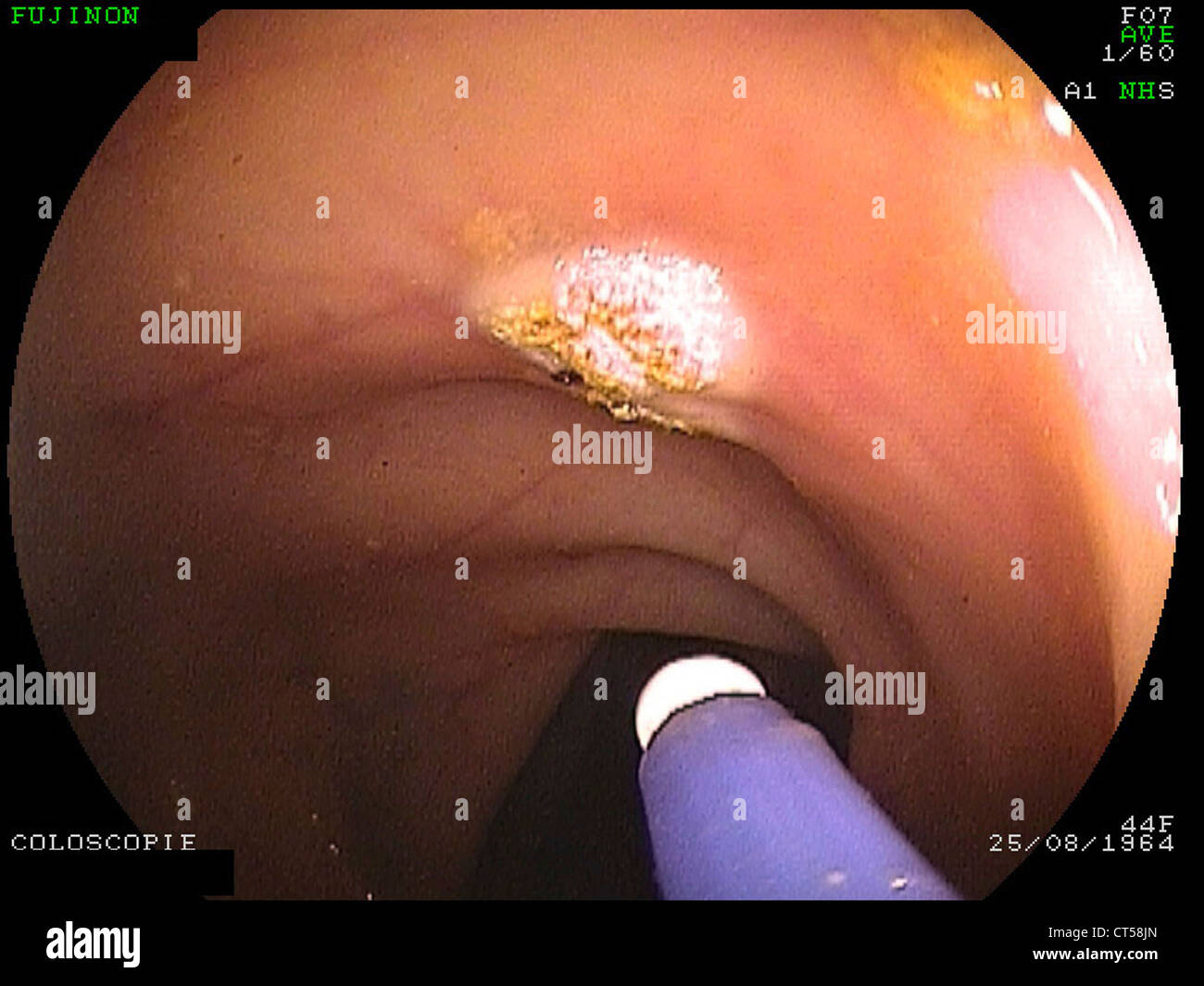 Angioma of the colon hi-res stock photography and images - Alamy