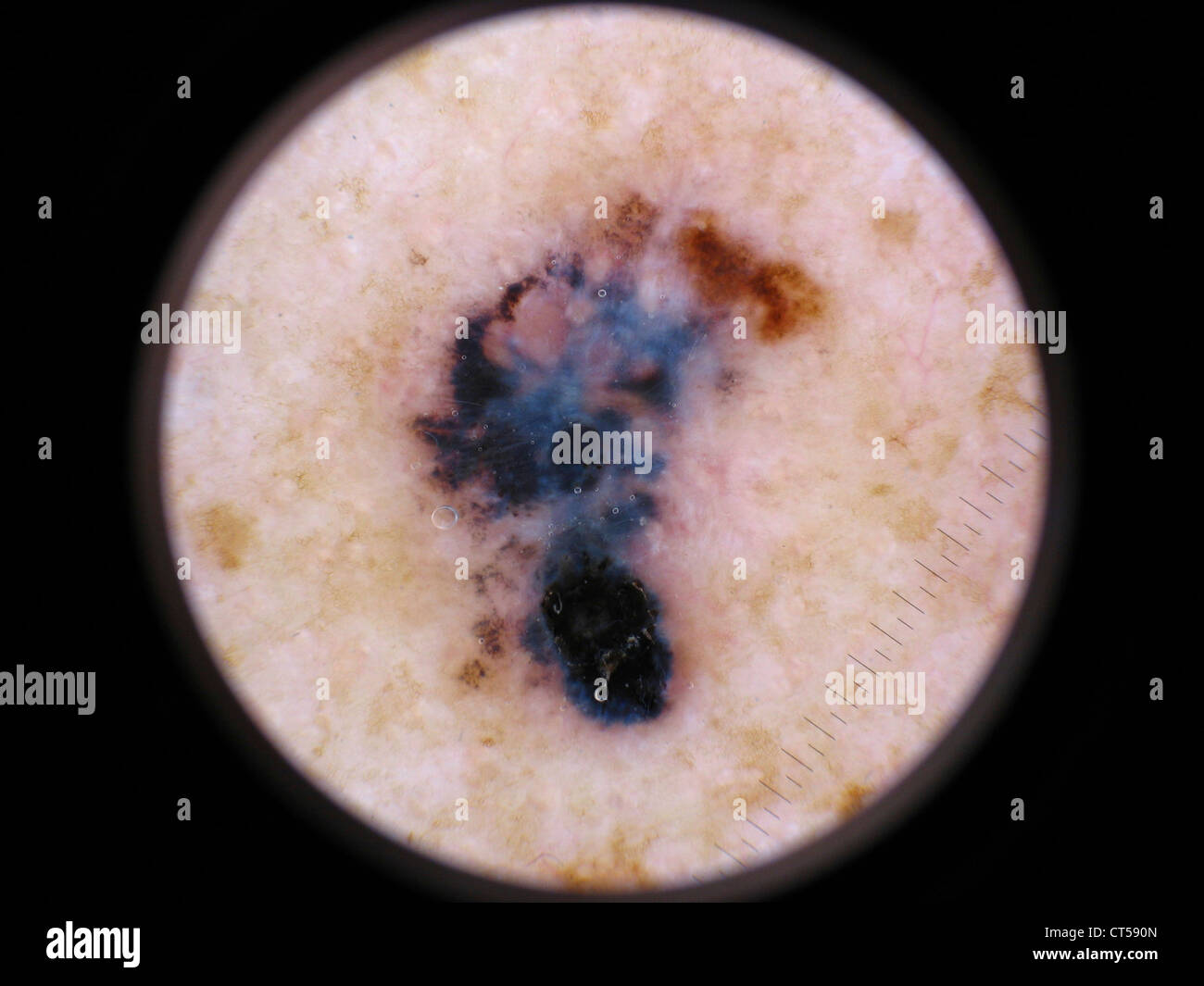 Malignant melanoma skin hires stock photography and images Alamy