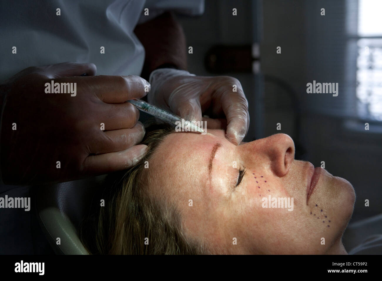 HYALURONIC ACID TREATMENT Stock Photo