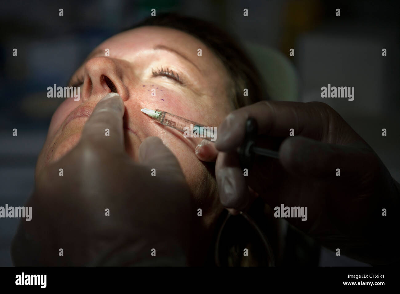 HYALURONIC ACID TREATMENT Stock Photo Alamy