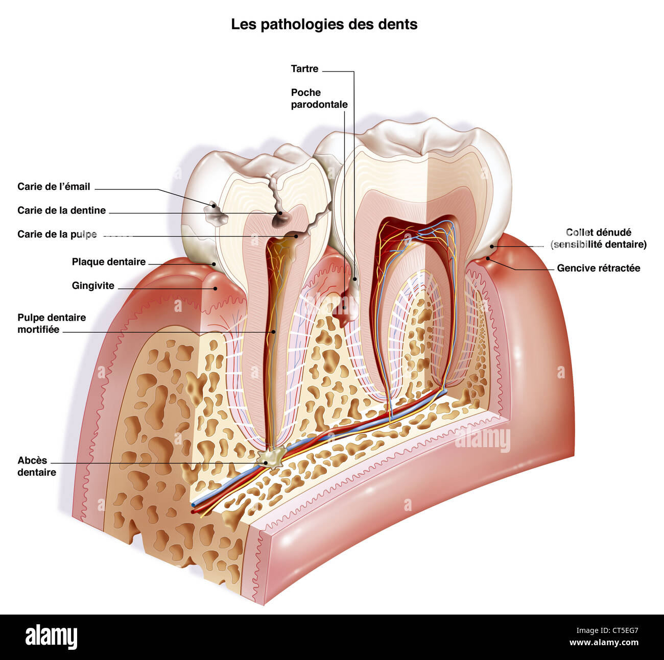 DENTAL PATHOLOGY, DRAWING Stock Photo