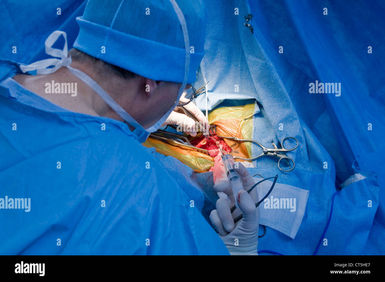 CAROTID, SURGERY Stock Photo