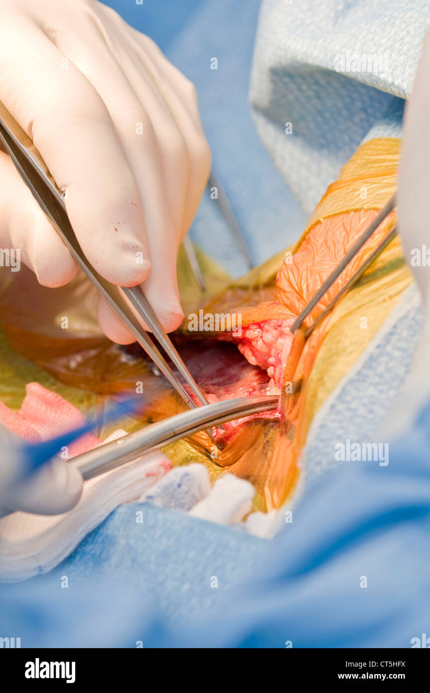 CAROTID, SURGERY Stock Photo