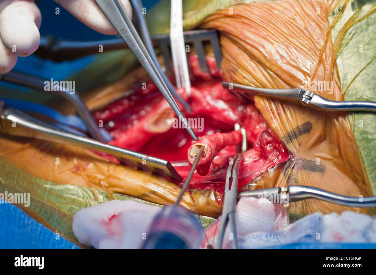 CAROTID, SURGERY Stock Photo