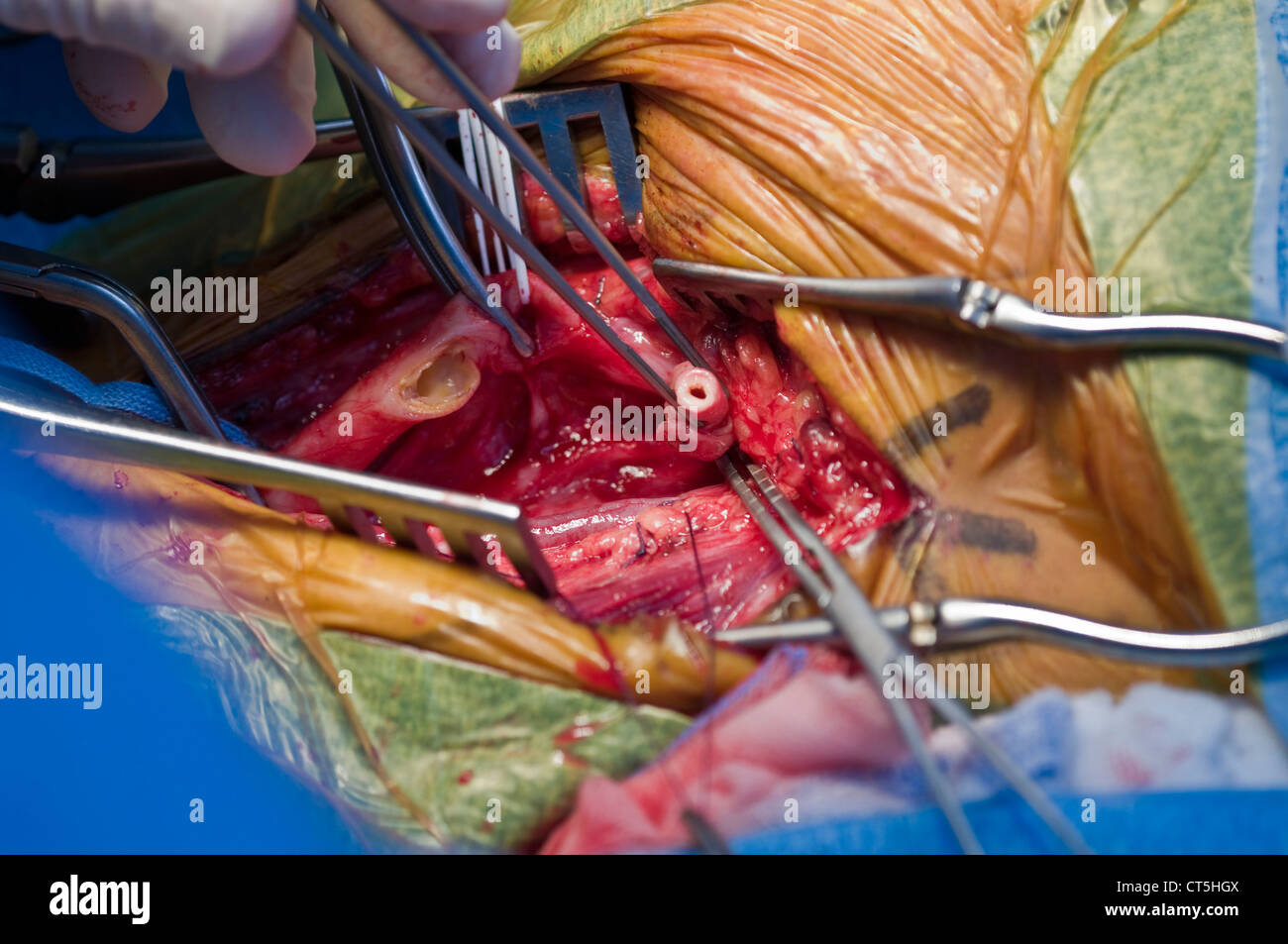 CAROTID, SURGERY Stock Photo