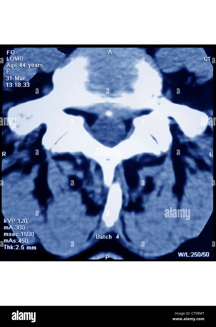 Herniated Disc CT Scan