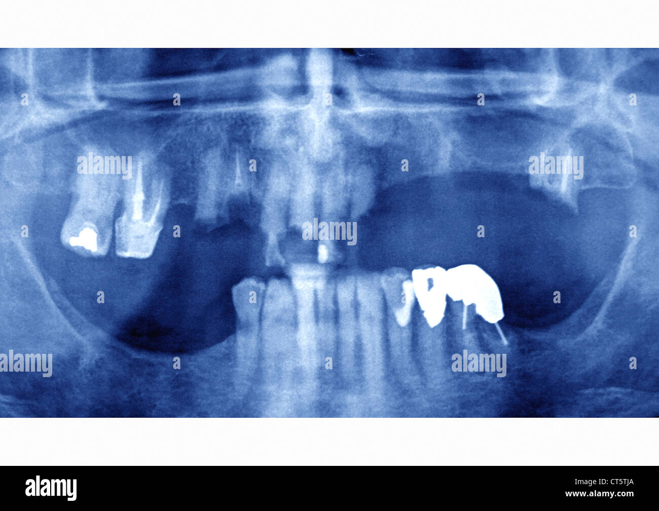 Dental x ray amalgam hires stock photography and images Alamy
