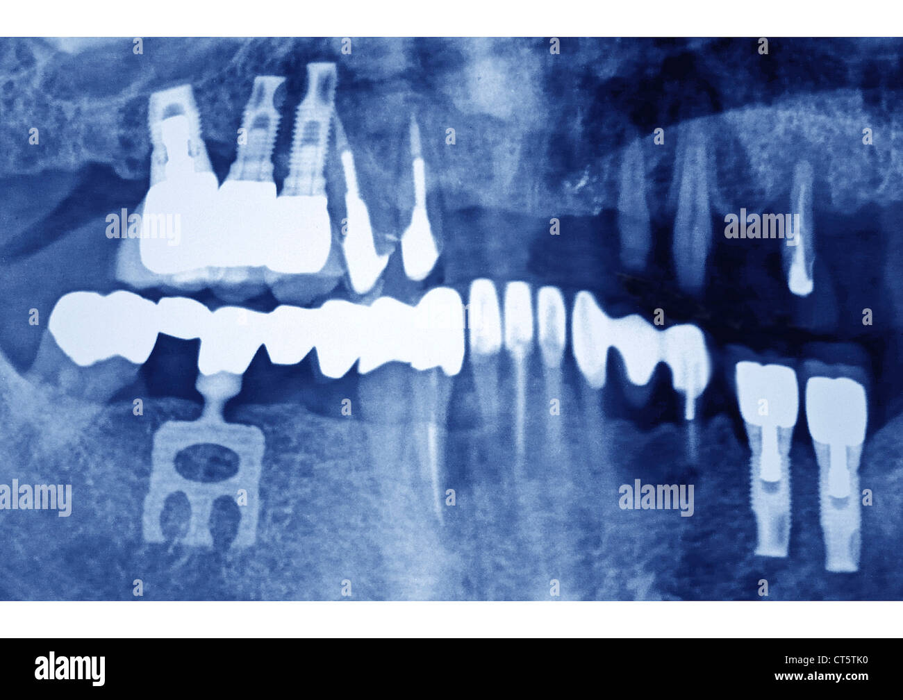 DENTAL IMPLANT, XRAY Stock Photo Alamy