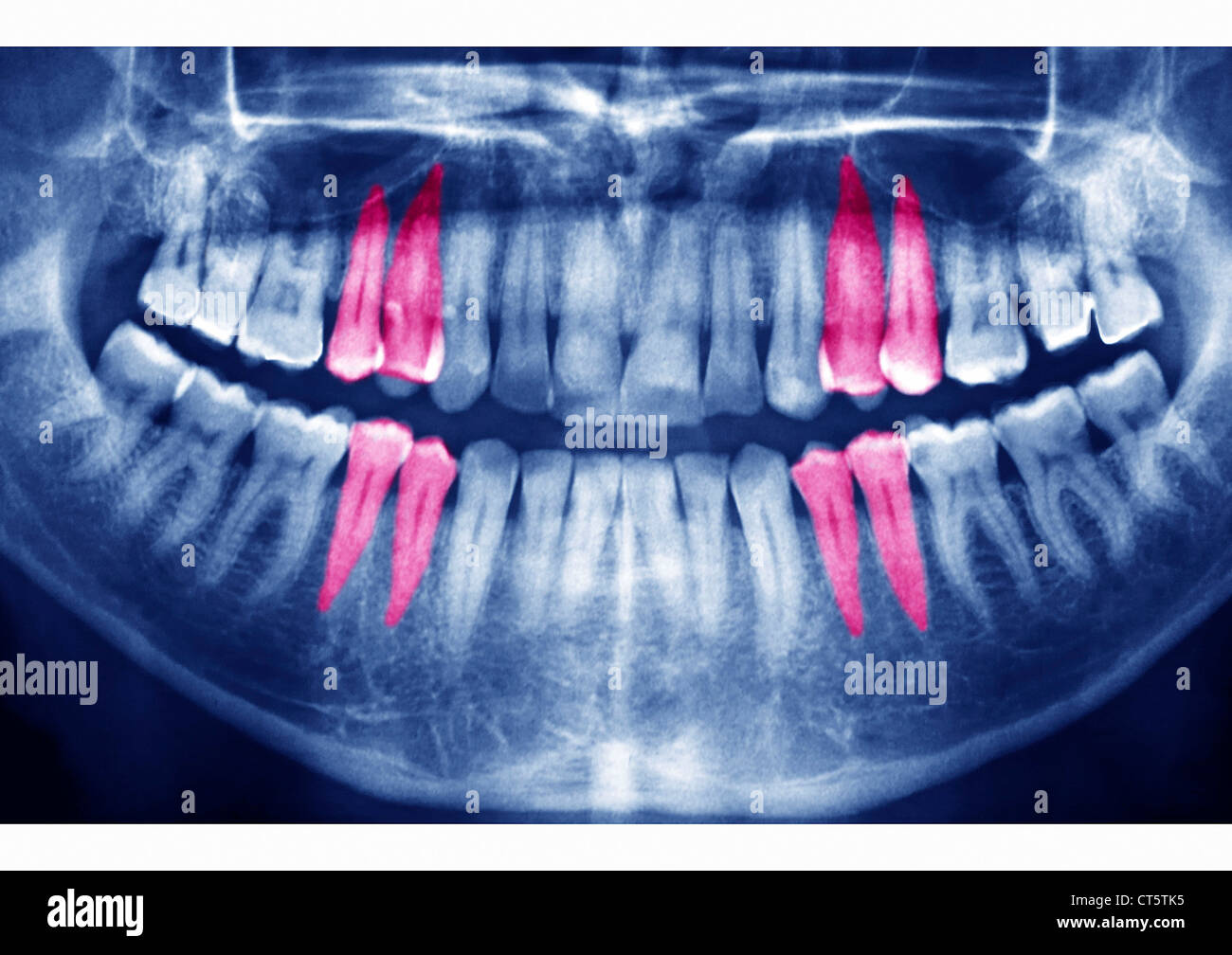 Dental radiogram hires stock photography and images Alamy