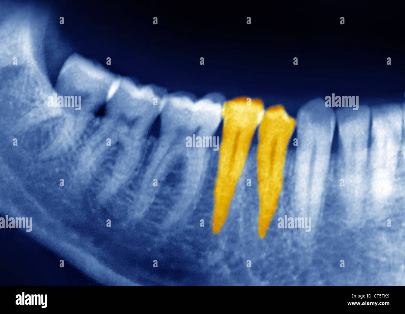 DENTAL XRAY RESULT Stock Photo Alamy