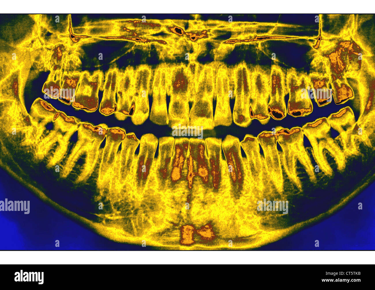 DENTAL XRAY RESULT Stock Photo Alamy