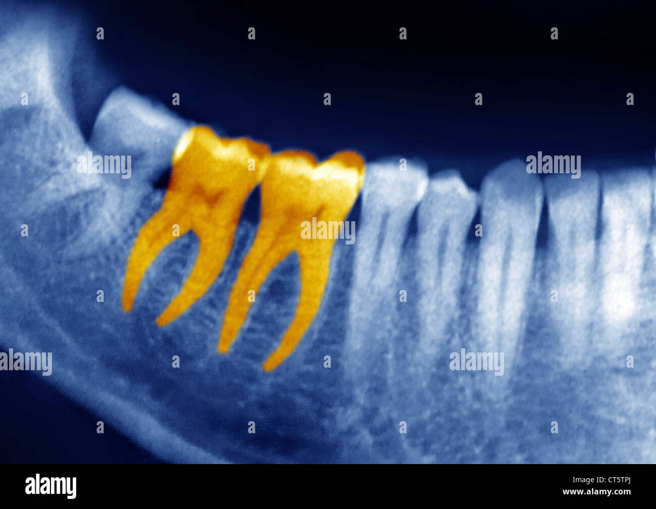 DENTAL XRAY RESULT Stock Photo Alamy