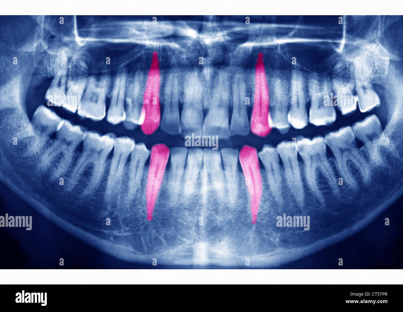 DENTAL X-RAY RESULT Stock Photo