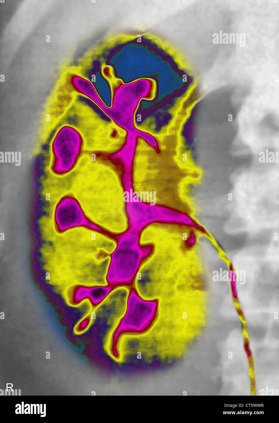 POLYCYSTIC KIDNEY DISEASE, XRAY Stock Photo Alamy