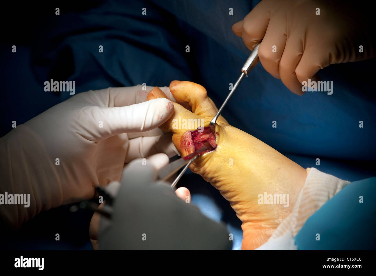 HALLUX VALGUS SURGERY Stock Photo