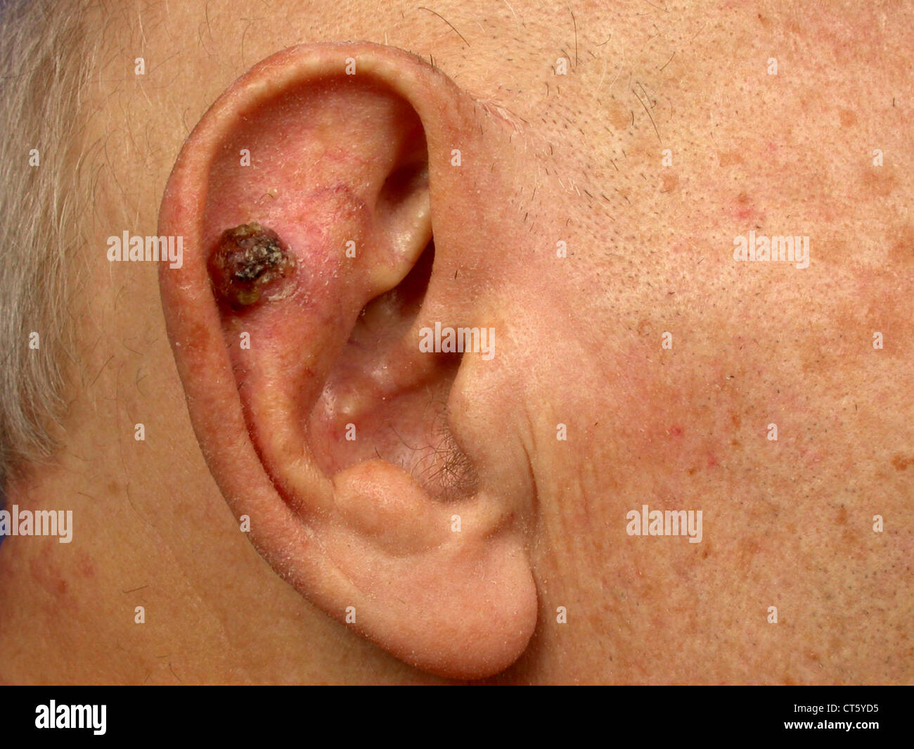 Squamous Cell Carcinoma Ear Hi Res Stock Photography And Images Alamy