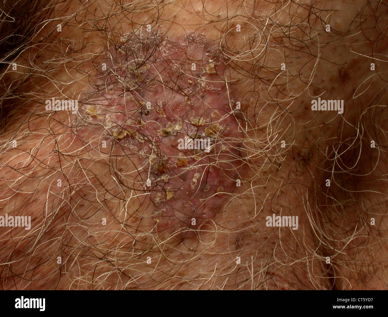 Mons Pubis Stock Photos & Mons Pubis Stock Images - Alamy