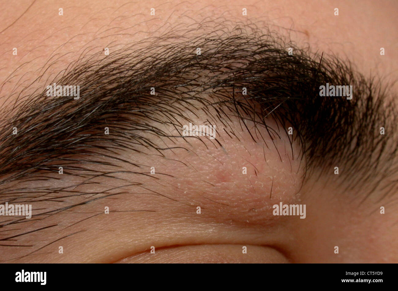 BENIGN SKIN TUMOR Stock Photo