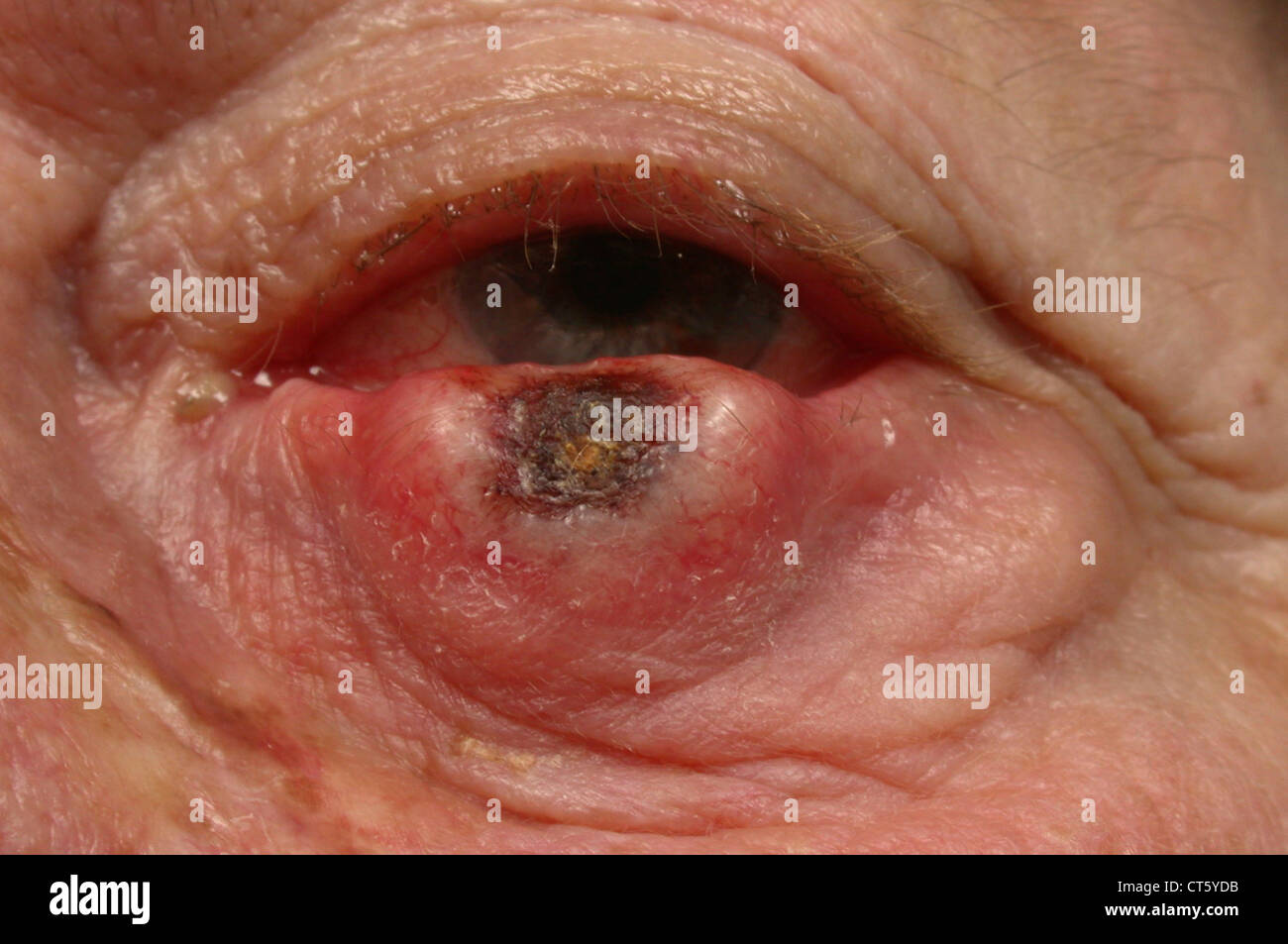 MALIGNANT TUMOR OF THE SKIN Stock Photo