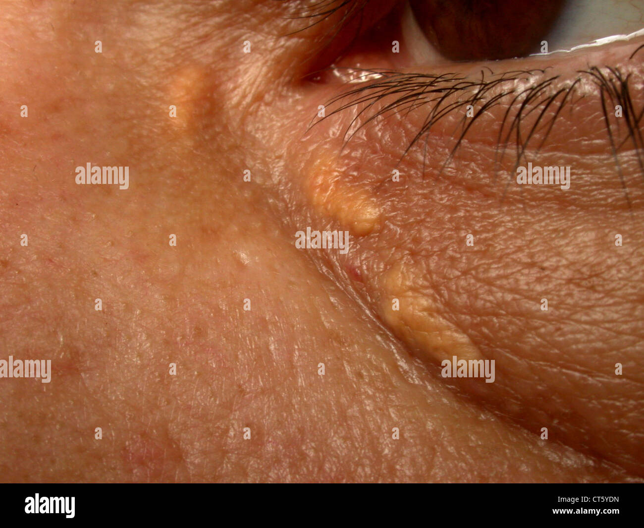 XANTHELASMA Stock Photo