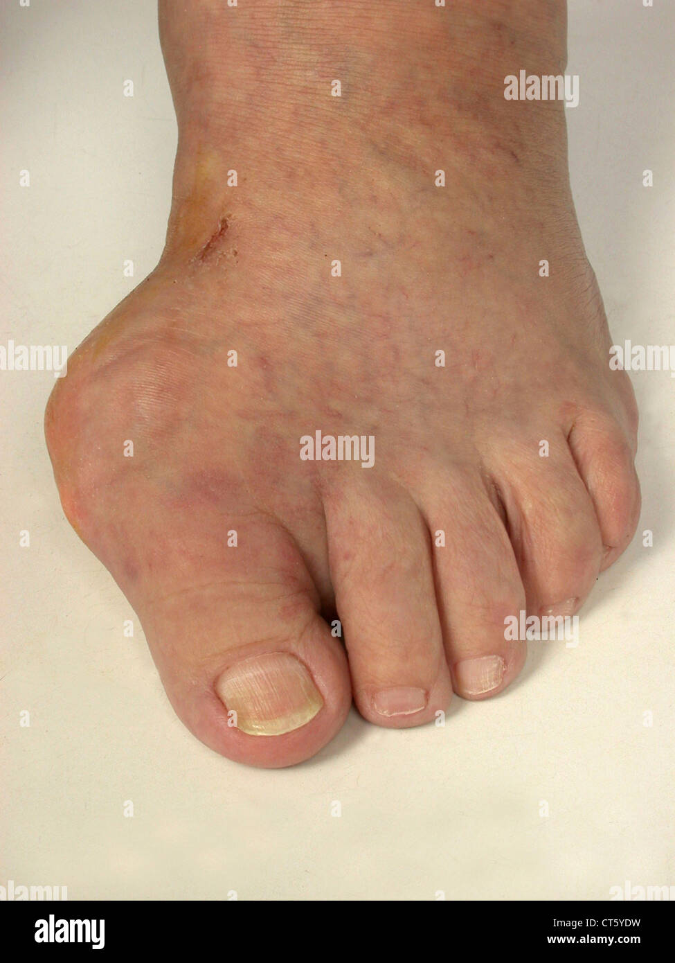 GOUTTY TOPHUS Stock Photo