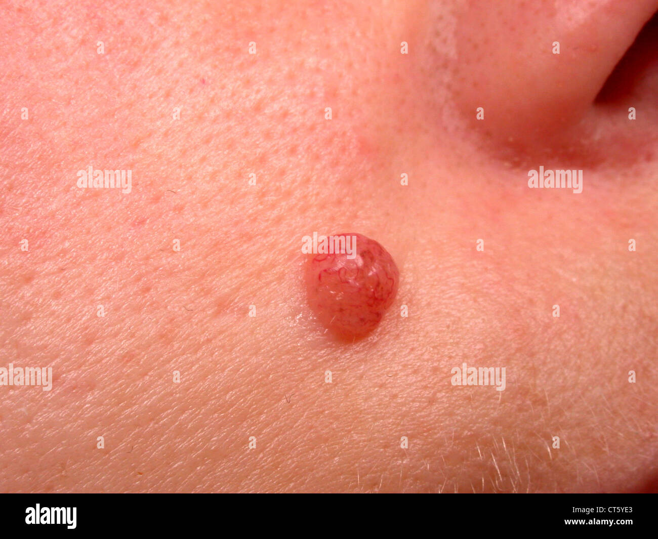 colordial nevus