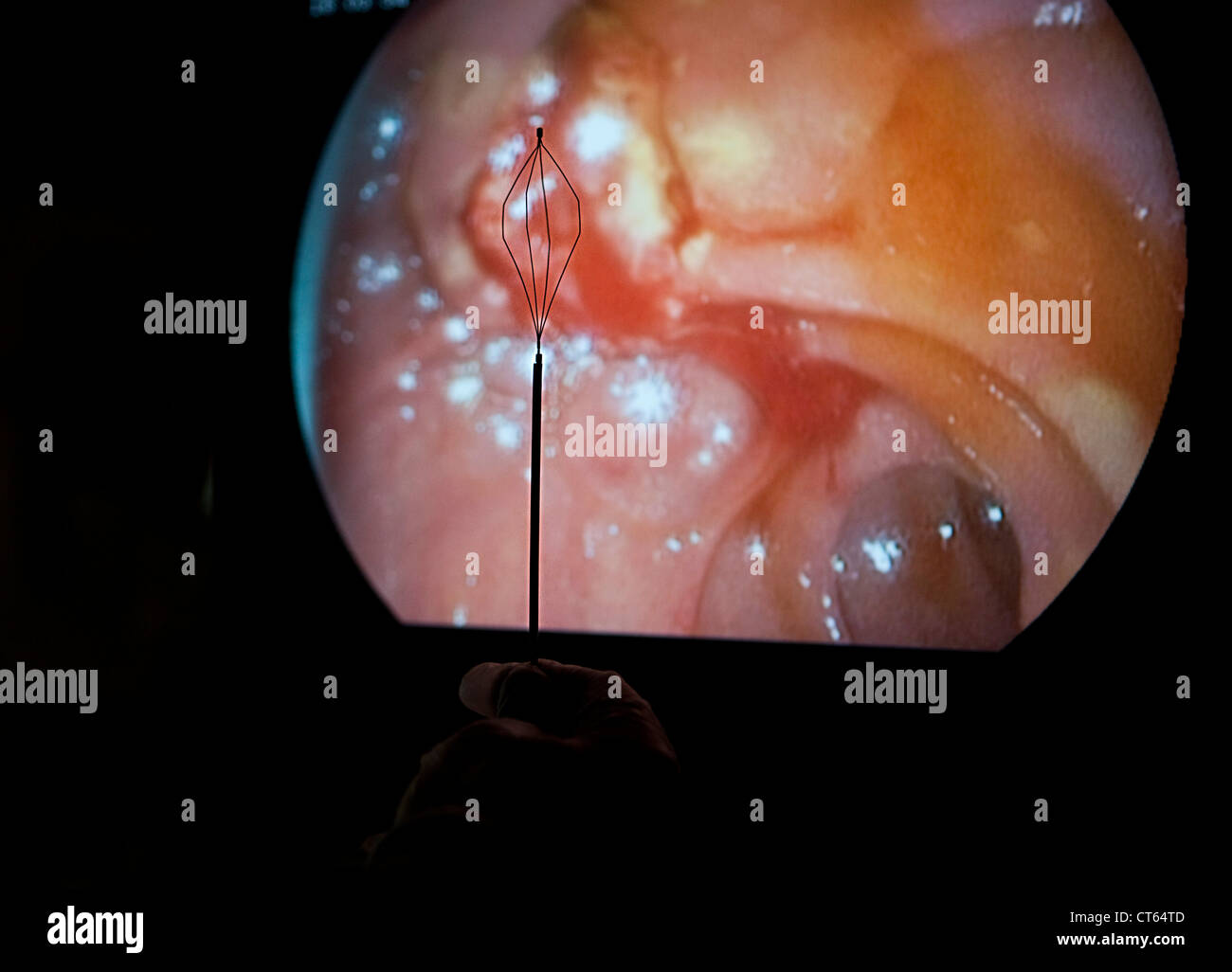 LITHIASIS, ENDOSCOPIC SURGERY Stock Photo Alamy