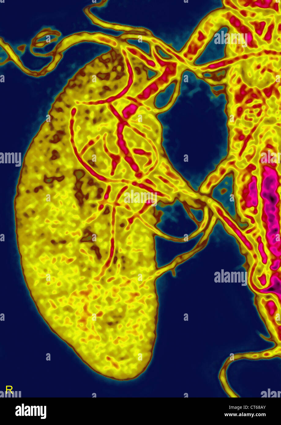 KIDNEY ARTERY, 3D SCAN Stock Photo