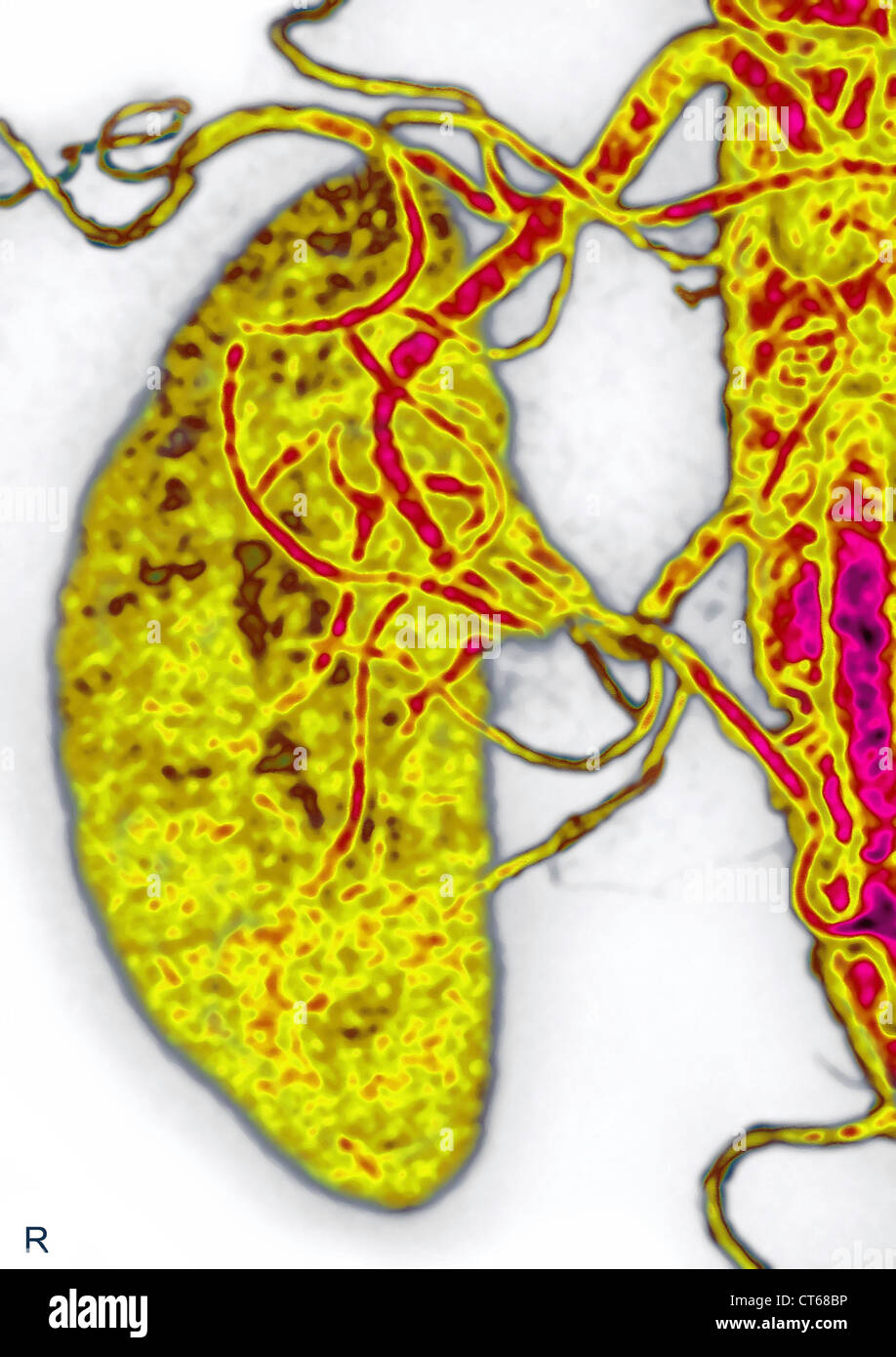Kidney arteries scan hires stock photography and images Alamy