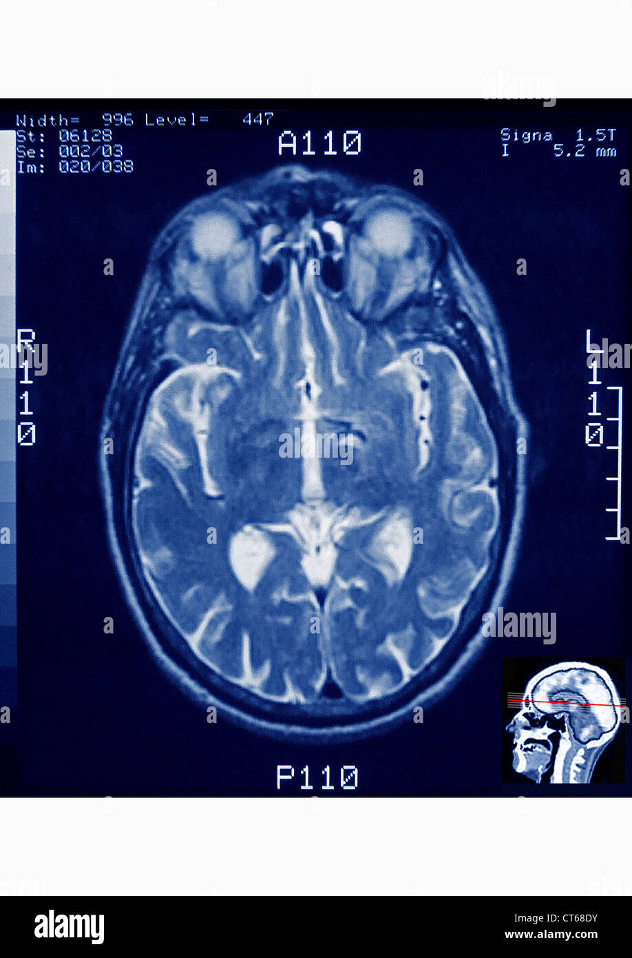 HEAD, MRI Stock Photo
