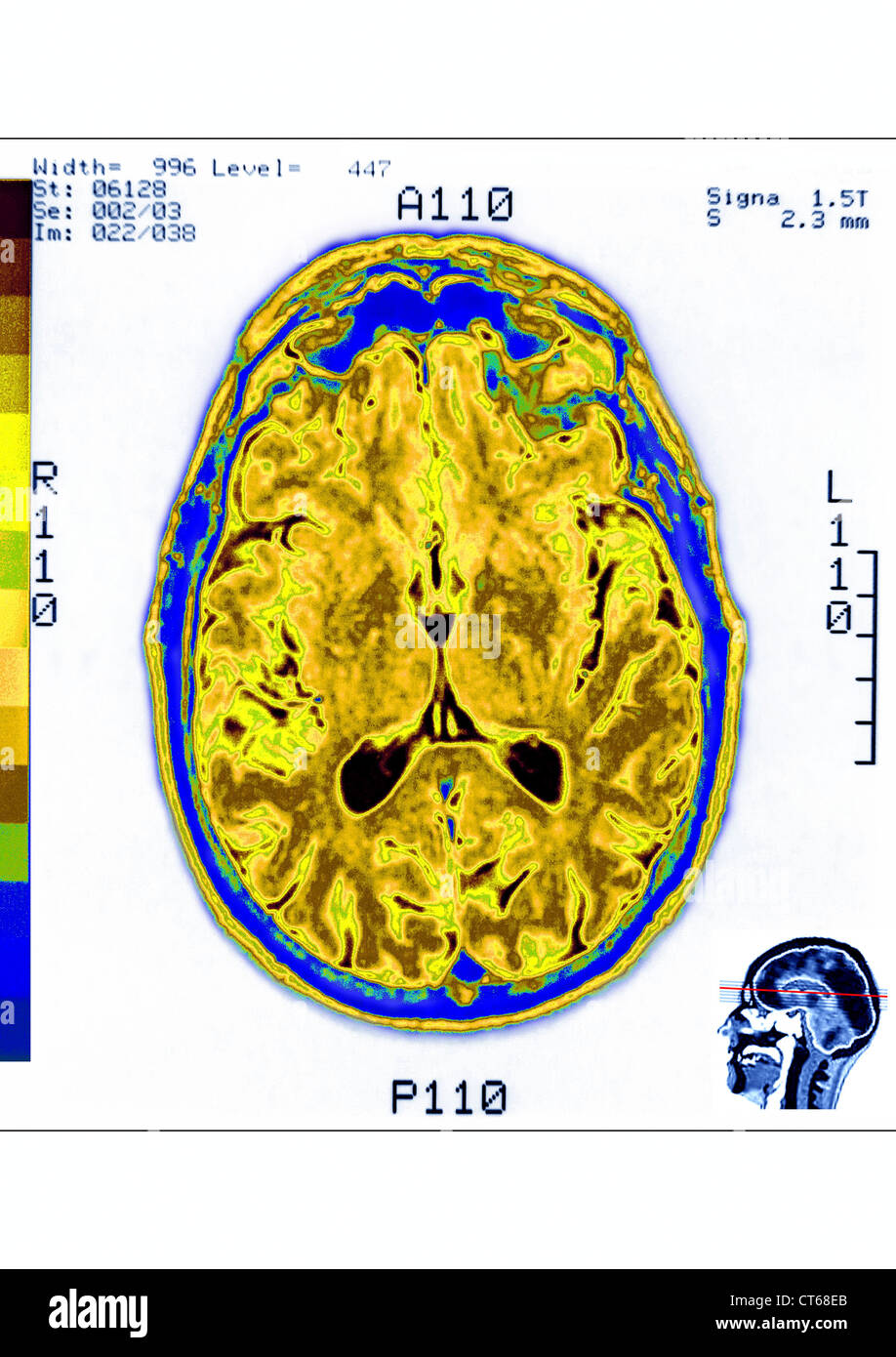 HEAD, MRI Stock Photo