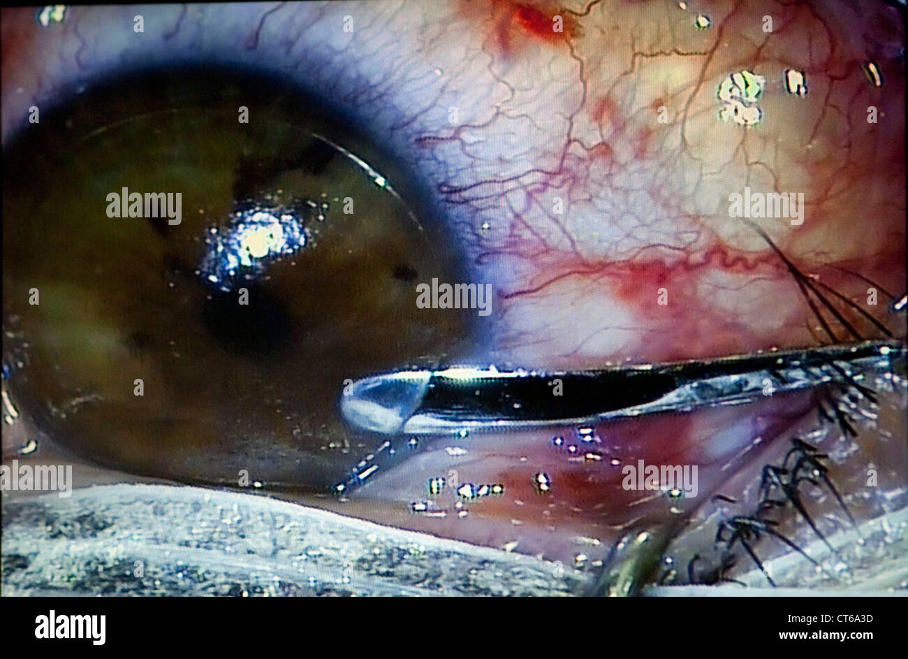 Laser Eye Surgery Stock Photos Laser Eye Surgery Stock Images