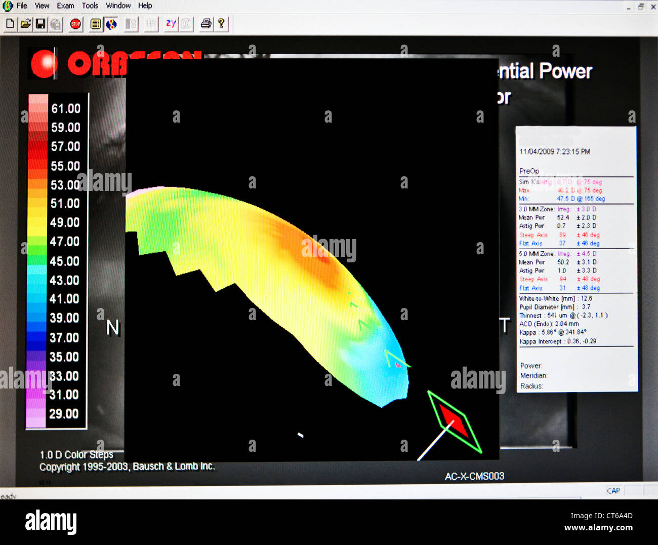 CORNEAL TOPOGRAPHY RESULT Stock Photo