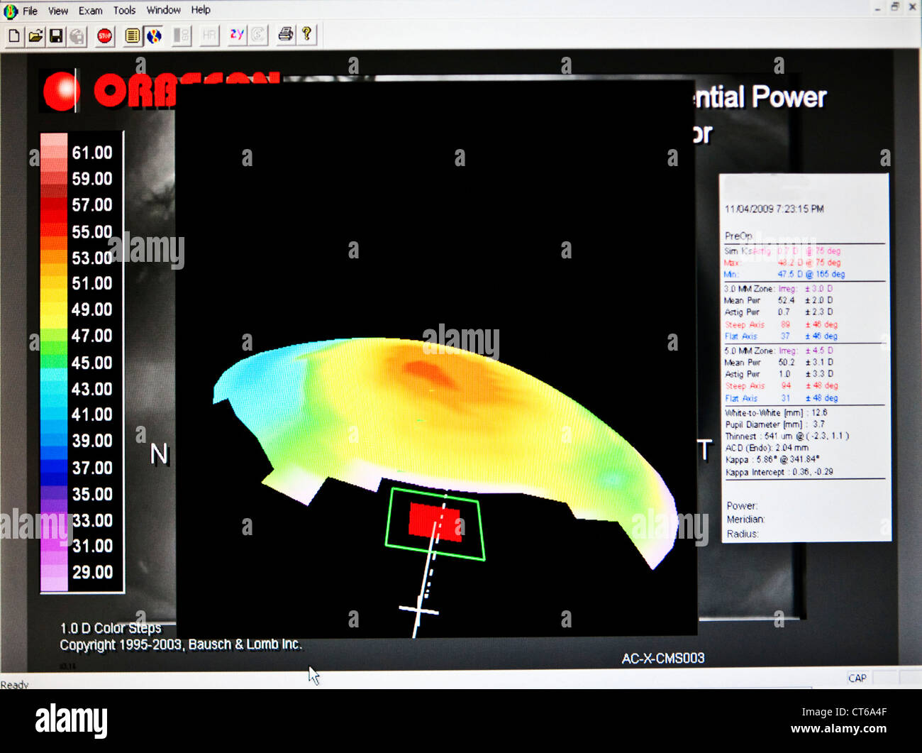 CORNEAL TOPOGRAPHY RESULT Stock Photo